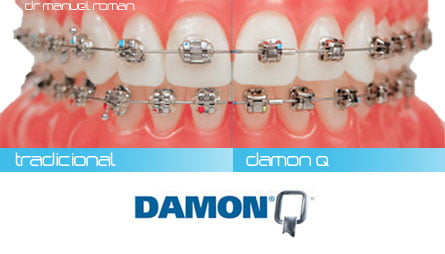 damon-ortodoncia-tradicional.jpg