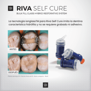 Riva Self Cure – Restauración duradera con tecnología ionglass™ - Imagen 3