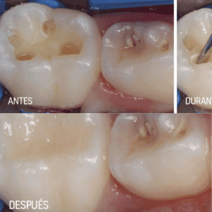 Luna Flow — Composite Fluido de Alta Resistencia y Estética Natural | SDI - Imagen 3